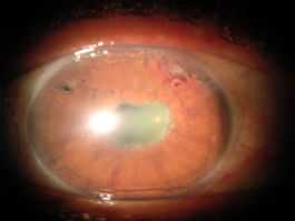 Neovascular Glaucoma-Rubeosis
