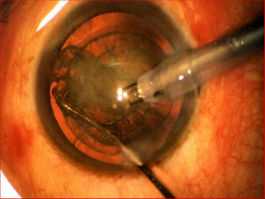 Phacoemulsification-Removal of Cataract Thru 2.2mm Incision