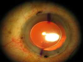 Toric Intraocular Lens to orrect Astigmatism During Cataract Surgery