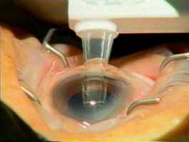 Cataract Surgery-Foldable Intraocular Lens Being Injected in Eye