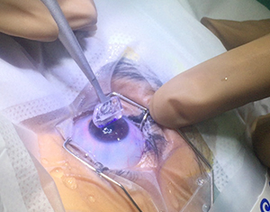 Cataract treatment in Gurgaon