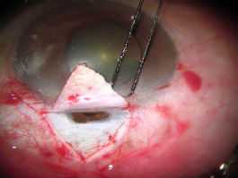 Trabeculectomy-Glaucoma Filtering Surgery